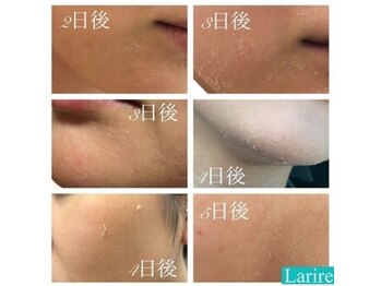 ラリール(Larire)/剥けるハーブピーリング