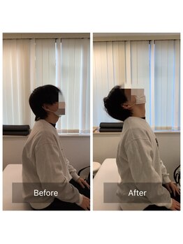 ナオル整体 新宿院(NAORU整体)/30代男性-姿勢矯正1ヶ月経過