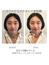 スクナビコナ鍼灸院/美容ハリのビフォーアフター