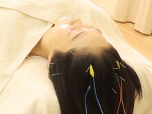 ノアの雰囲気（頭の鍼でたるみに働きかけ小顔に導きます♪【美容鍼・鍼灸】）