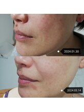 RiとBiのたまご/（フェイシャル）美肌　シミ