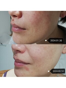 RiとBiのたまご/（フェイシャル）美肌　シミ