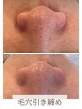 オリエンタルビューティー(ORIENTAL BEAUTY)/ハーブピーリング×毛穴洗浄