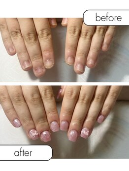 ピノ(pino)/◆深爪矯正＋5ミリ長さだし◆