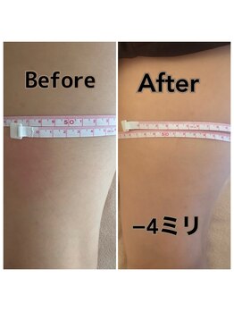 温活ルーム たまご肌/太腿一度の施術でマイナス4ミリ