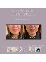 デフィ(Defi)/プラズマ×脂肪分解