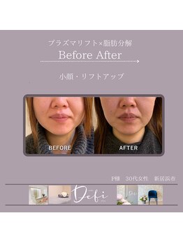 デフィ(Defi)/プラズマ×脂肪分解