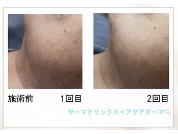 リル(Rire)/Before→After