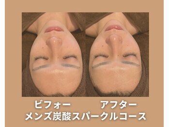 アオイスター(AOIstar)/メンズフェイシャル　炭酸☆