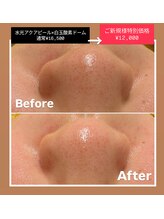 クレール 小山店(CLAIR)/【毛穴洗浄】１回の効果