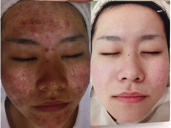 ジェニックサロン グランドギンザ ひたちなか(GENIC SALON GRAND GINZA)/ 日本一の肌改善サロンの実力