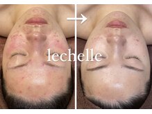 レシェルサロン(Lechelle Salon)/ハーブピーリング12回