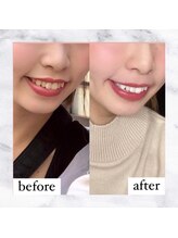 ライトケアサロン 表参道店(Light Care Salon)/ホワイトニングの効果