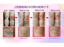 エムズ ラウンジ 上大岡店(M's Lounge)/脱毛照射後の経過