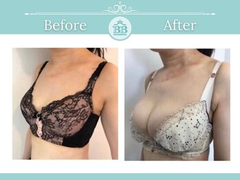 美人バスト 岡崎店/【バストアップ★育乳】症例