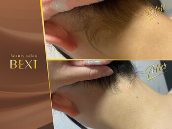 ベクスト(BEXT)/うなじ脱毛(PRO)