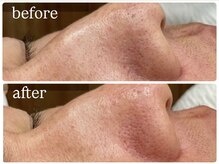 ビノスビューティー(vinos.beauty)/症例写真　毛穴洗浄/毛穴/黒ずみ