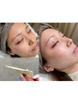 顔脱毛がしたい