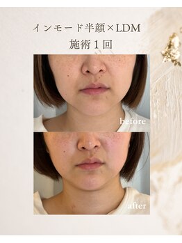 フォルディオ(FORDIO)/インモード半顔×LDM