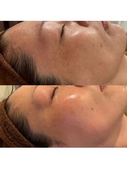 ローズマリー(rosemary)/1番人気【本格シミケア】