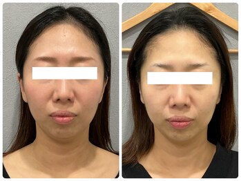 エミマス ボーテ(Emimas Beaute’)/2回で別人級!!スッキリ小顔へ♪