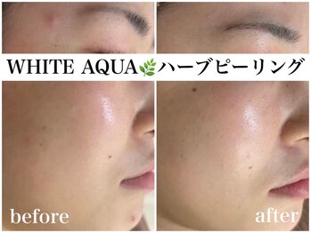 アワピール 天王寺店(AWA PEELL)/ハーブピーリング/ニキビケア