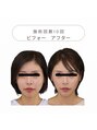 ワンモア 新町店(1MORE) 食い縛り、歯ぎしり エラがお悩みのお客様