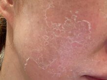 スキンケアスタジオ アコ 新宿店(Aco)/グリーンピールソフト１D4日後