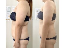 ミセル(MISEL)/キープ力◎リピートNo,1最新痩身