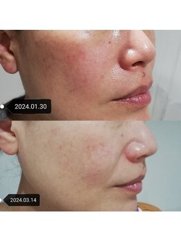 RiとBiのたまご/（フェイシャル）美肌　敏感肌