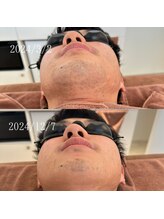 アゲハ(ageha)/メンズ/髭脱毛