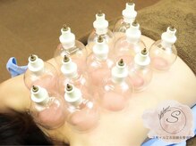 スマイル江古田鍼灸整体院の雰囲気（お悩みの箇所にカッピングによりコリ、血流改善を致します）