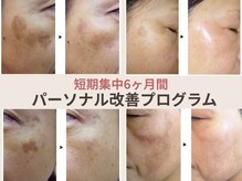 エヴェリーナ(Eveliiina)/ドクターピュールボーテ改善