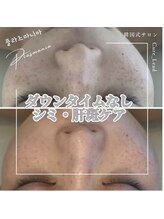 キュアリード(Cure_Lead)/ダウンタイムなしのシミケア