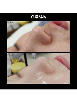 パールブルー(All Perl blue)/韓国エステ月2回コース