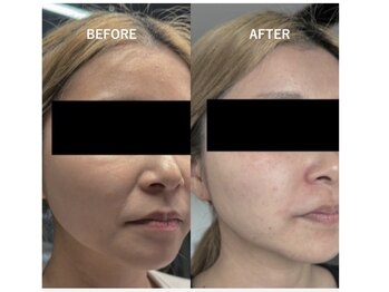 サロン リノ(salon rino)/【韓国小顔】メシダ脂肪分解