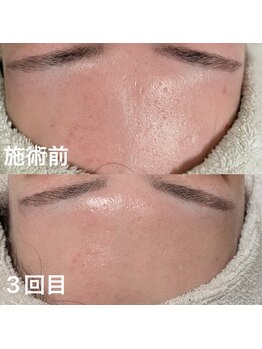 オンド(OND)/クレー'ター、ニキビ'跡、赤みに