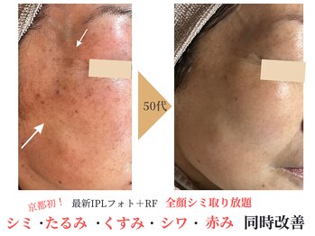 エソア(esoa)の写真/【医療提携×シミ肌改善×美肌】潜んだシミ、頑固なシミにも根本からアプローチ♪年齢を感じさせない美肌へ
