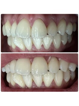 ラブホワイトニング 渋谷店(LOVEホワイトニング)/初回2回照射ホワイトニング