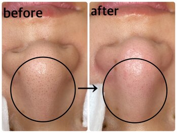 毛穴専科/韓国肌管理◇ 学割u24あり