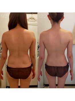 ミールーム(mi room)/痩身エステ３ヶ月