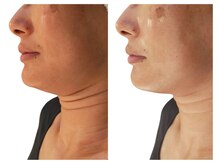 ベリッセ(Belisse)/レモンボトル＊BBL＊MCS96