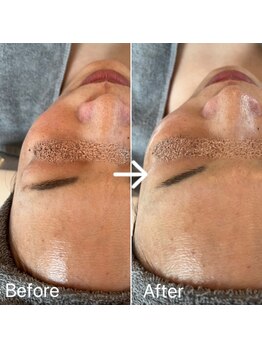 ブルームーン(Blue Moon)/ララピール施術前後