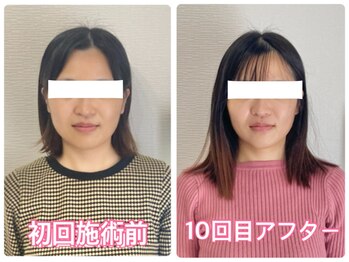 アールプラスラボ(R+labo)/骨格から小顔矯正ビフォアフ