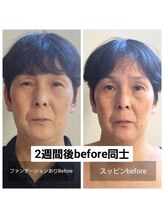ニコ(Nico)/before・after　小顔・姿勢矯正