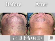 ビューティーアンドボディメイクBB シャオ西尾店/ヒゲだけでなく肌質も改善！