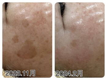 アップル 宇都宮店(Apple.)/肌改善プログラム