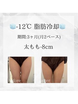 メディカルエステ 東銀座店/-12℃脂肪冷却 before/after