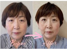 アシュネ(Axiune)/50代★小顔矯正”たるみ改善”