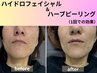 【肌質改善No.1】毛穴・ニキビ・くすみ徹底ケア♪ハイドロ+ハーブピーリング